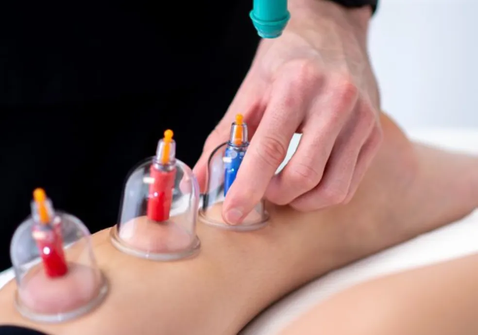 Cupping